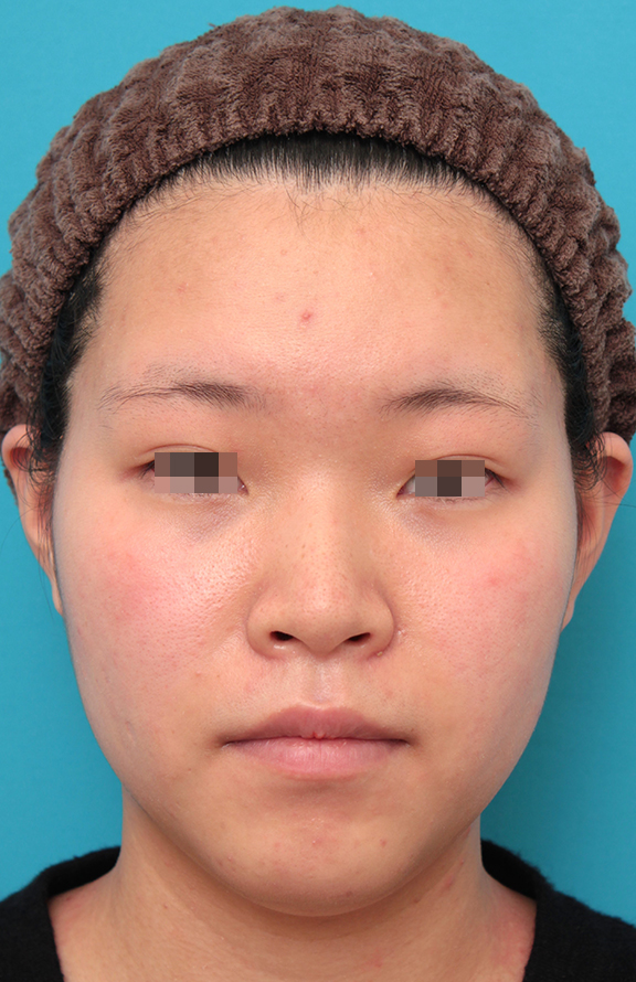 症例写真,鼻シリコンプロテーゼ＋鼻先耳介軟骨移植＋小鼻縮小を行った20代女性の症例写真,Before,ba_ryubi1065_b01.jpg