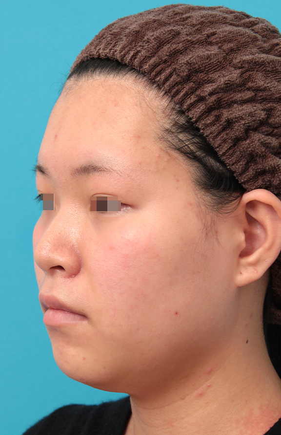 症例写真,鼻シリコンプロテーゼ＋鼻先耳介軟骨移植＋小鼻縮小を行った20代女性の症例写真,Before,ba_ryubi1065_b02.jpg