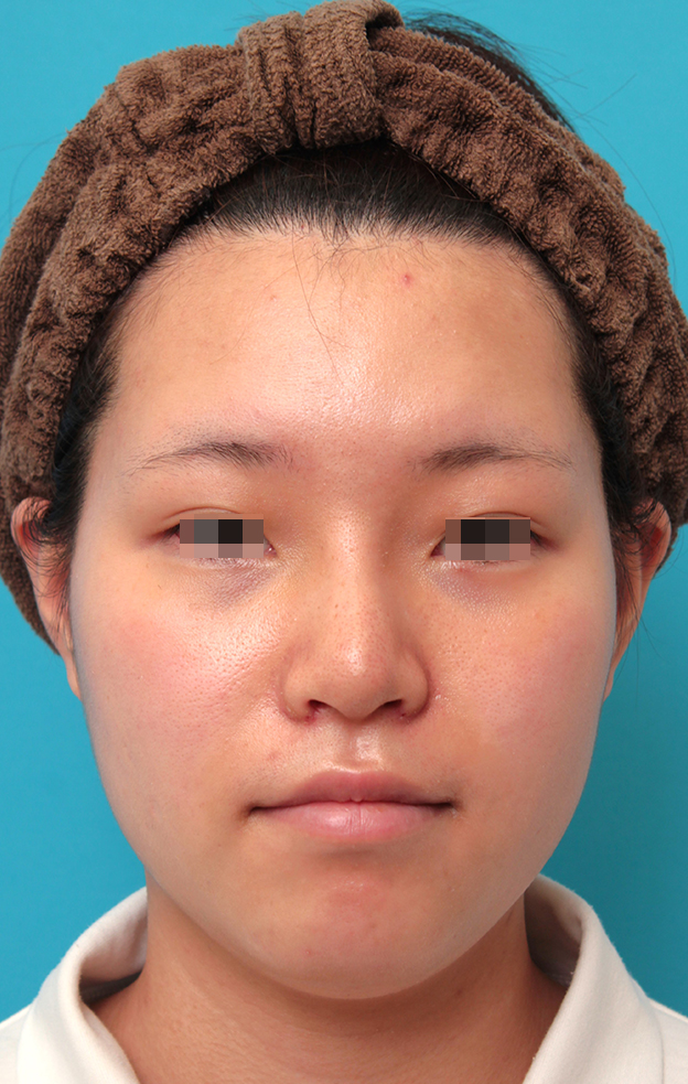 隆鼻術（シリコンプロテーゼ）,鼻シリコンプロテーゼ＋鼻先耳介軟骨移植＋小鼻縮小を行った20代女性の症例写真,1週間後,mainpic_ryubi1065c.jpg