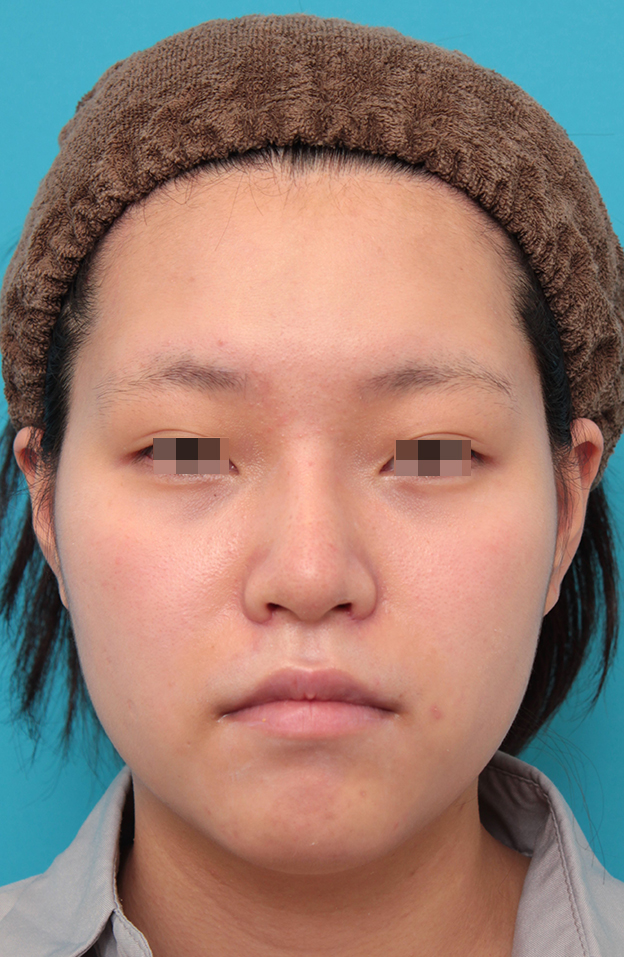 耳介軟骨移植（鼻先を出す）,鼻シリコンプロテーゼ＋鼻先耳介軟骨移植＋小鼻縮小を行った20代女性の症例写真,1ヶ月後,mainpic_ryubi1065d.jpg