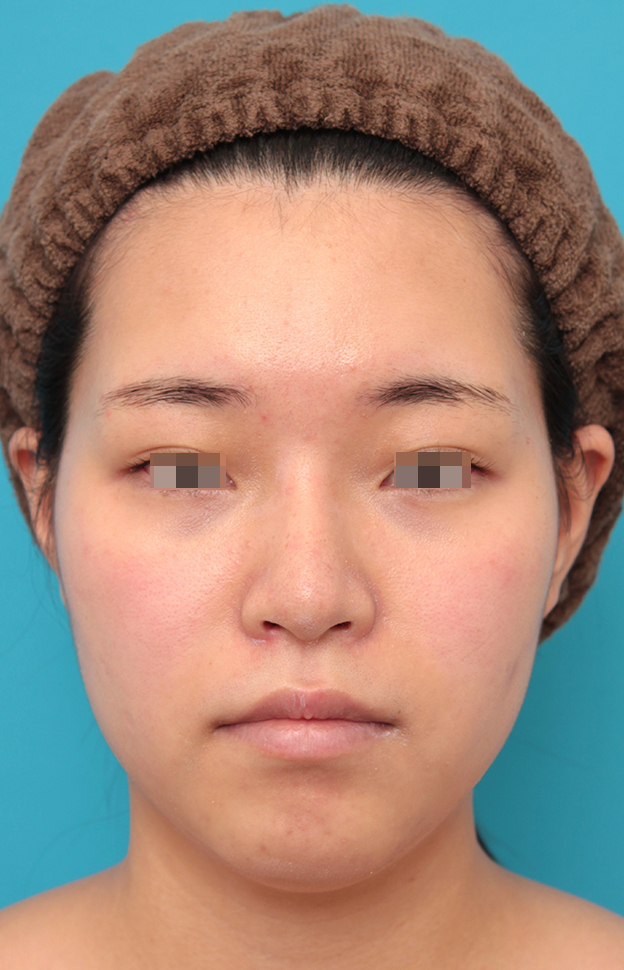 耳介軟骨移植（鼻先を出す）,鼻シリコンプロテーゼ＋鼻先耳介軟骨移植＋小鼻縮小を行った20代女性の症例写真,2ヶ月後,mainpic_ryubi1065e.jpg