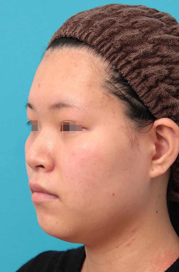 耳介軟骨移植（鼻先を出す）,鼻シリコンプロテーゼ＋鼻先耳介軟骨移植＋小鼻縮小を行った20代女性の症例写真,手術前,mainpic_ryubi1065f.jpg