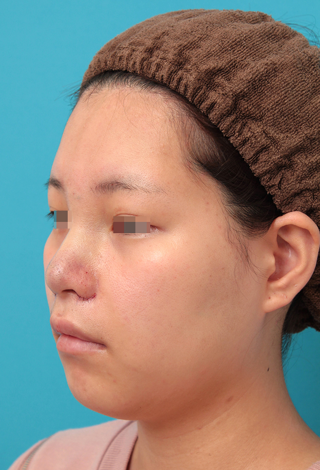 隆鼻術（シリコンプロテーゼ）,鼻シリコンプロテーゼ＋鼻先耳介軟骨移植＋小鼻縮小を行った20代女性の症例写真,手術直後,mainpic_ryubi1065g.jpg