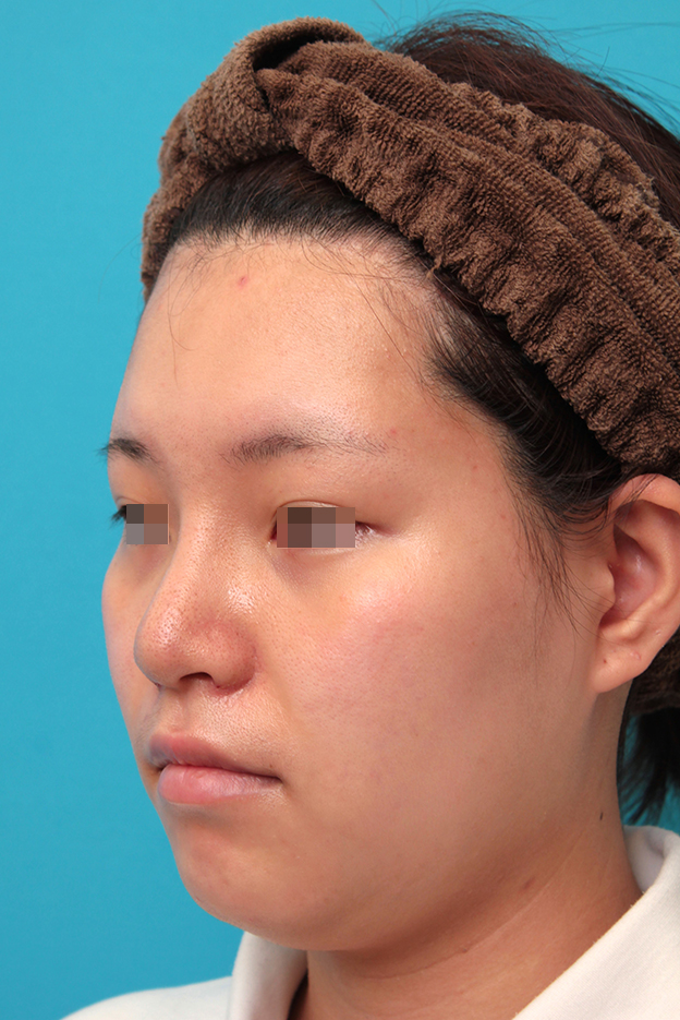 隆鼻術（シリコンプロテーゼ）,鼻シリコンプロテーゼ＋鼻先耳介軟骨移植＋小鼻縮小を行った20代女性の症例写真,1週間後,mainpic_ryubi1065h.jpg