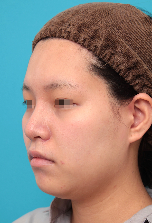 隆鼻術（シリコンプロテーゼ）,鼻シリコンプロテーゼ＋鼻先耳介軟骨移植＋小鼻縮小を行った20代女性の症例写真,1ヶ月後,mainpic_ryubi1065i.jpg