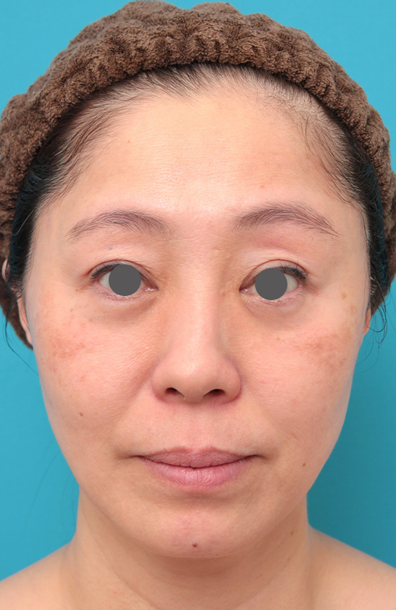 ミディアムフェイスリフト,ミディアムフェイスリフトを行った50代女性症例写真,After（6ヶ月後）,ba_mediumlift024_a01.jpg