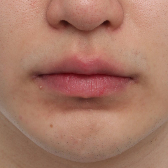 唇を薄く（口唇縮小術）,唇の厚みを薄くして爽やかな印象になった症例写真,After（6ヶ月後）,ba_usuku023_a01.jpg
