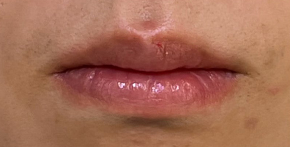 唇を薄く（口唇縮小術）,口唇縮小術で唇を薄くした症例写真,After（1ヶ月後）,ba_usuku024_a01.jpg