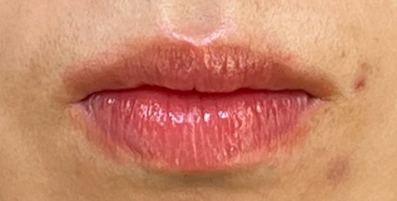 唇を薄く（口唇縮小術）,口唇縮小術で唇を薄くした症例写真,Before,ba_usuku024_b01.jpg