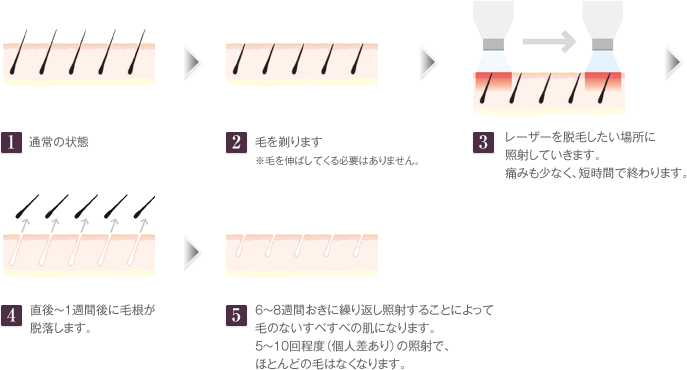 1.通常の状態。2.毛を剃ります。※毛を伸ばしてくる必要はありません。3.レーザーを脱毛したい場所に照射していきます。痛みも少なく、短時間で終わります。4.直後～1週間後に毛根が脱落します。5.6～8週間おきに繰り返し照射することによって毛のないすべすべの肌になります。5～10回程度（個人差あり）の照射で、ほとんどの毛はなくなります。