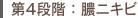 第4段階:膿ニキビ
