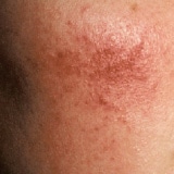 赤ら顔・ニキビ跡の赤みが気になる