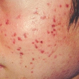 ニキビ・ニキビ跡が気になる