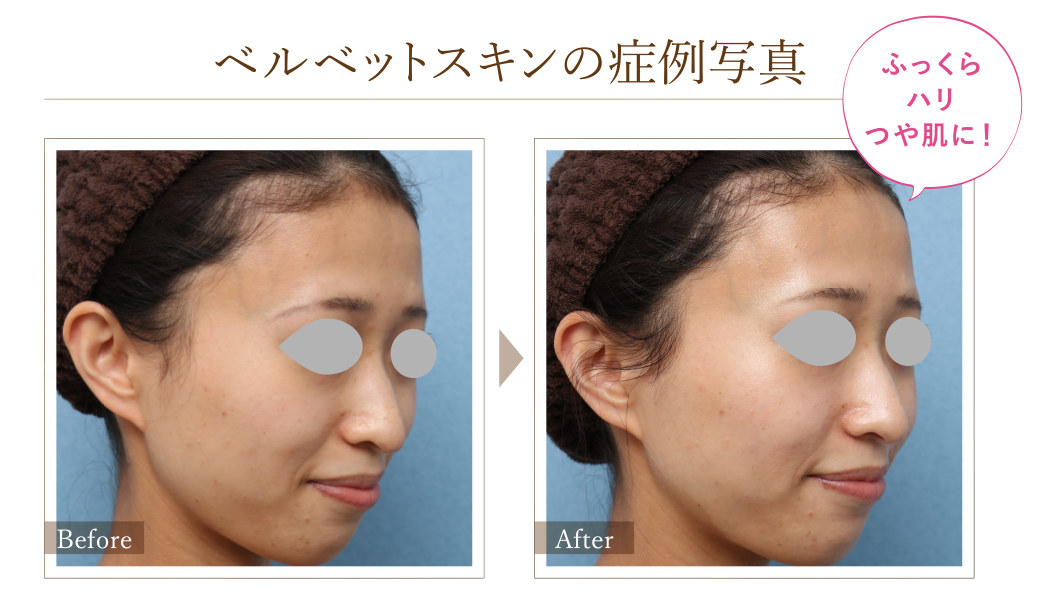 ベルベットスキンの症例写真 Before/After ふっくらハリつや肌に！