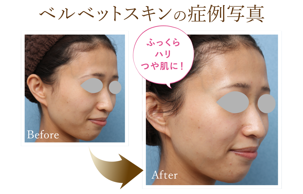 ベルベットスキンの症例写真 Before/After ふっくらハリつや肌に！