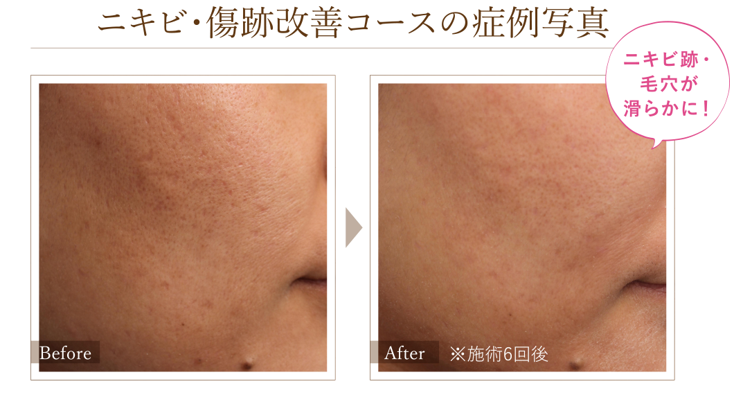 ニキビ・傷跡改善コースの症例写真 Before/After(※施術6回後) ニキビ跡・毛穴が滑らかに!