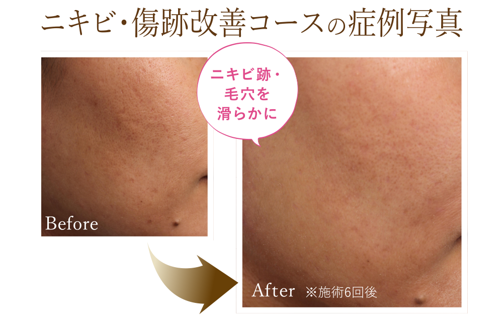 ニキビ・傷跡改善コースの症例写真 Before/After(※施術6回後) ニキビ跡・毛穴が滑らかに!