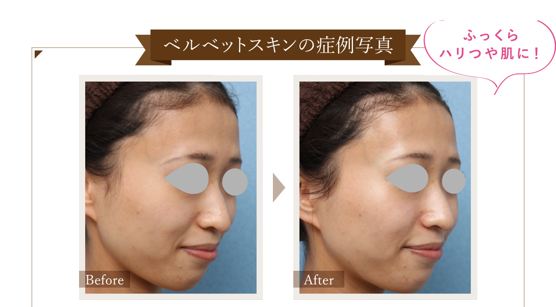 ベルベットスキンの症例写真 Before/After ふっくらハリつや肌に！