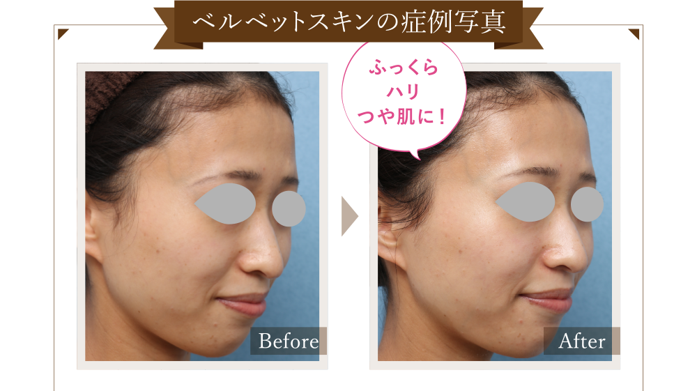 ベルベットスキンの症例写真 Before/After ふっくらハリつや肌に！