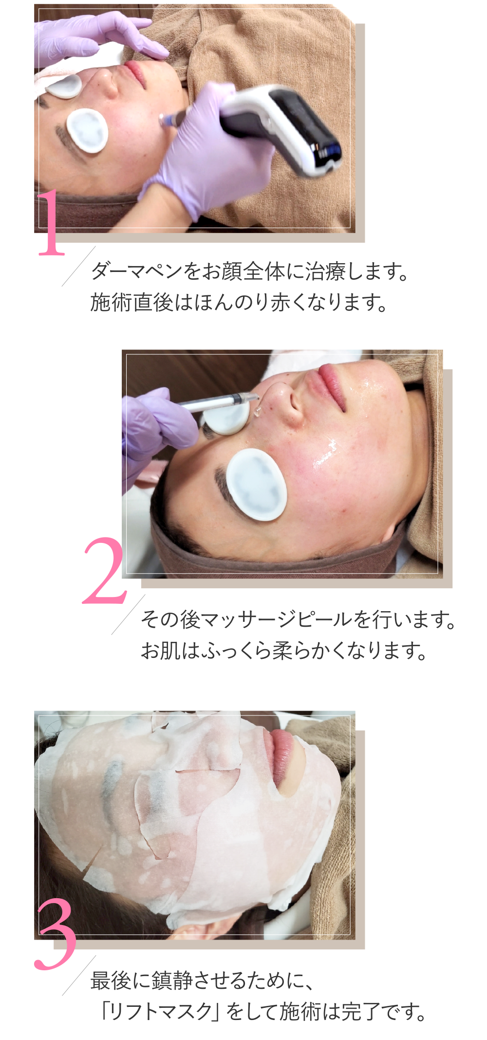 (1)ダーマペンをお顔全体に治療します。施術直後はほんのり赤くなります。(2)その後マッサージピールを行います。お肌はふっくら柔らかくなります。(3)最後に鎮静させるために、「リフトマスク」をして施術は完了です。