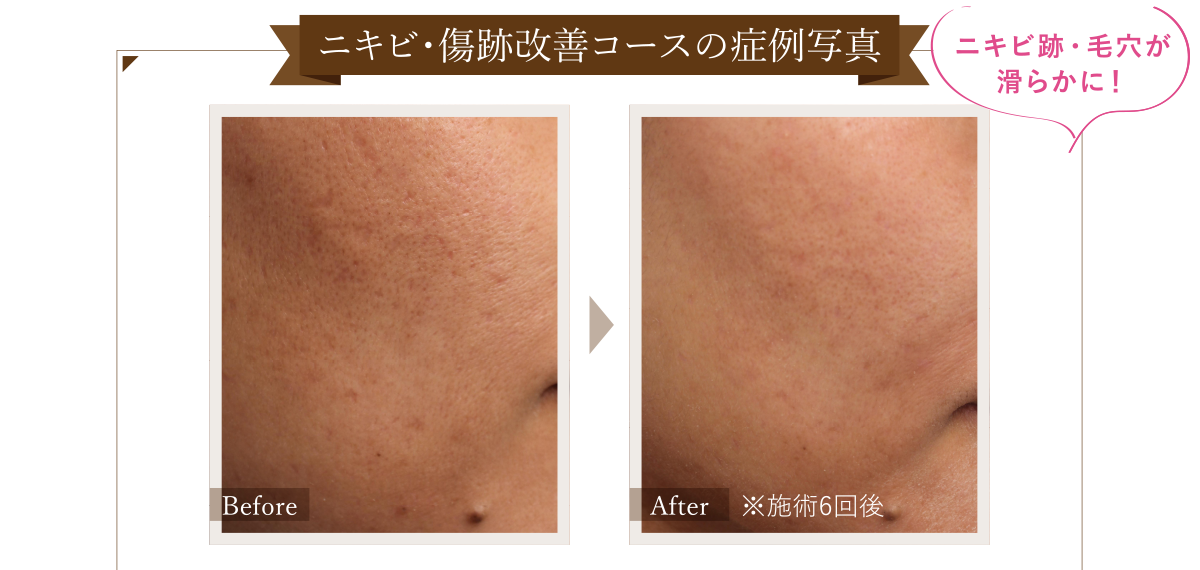 ニキビ・傷跡改善コースの症例写真 Before/After(※施術6回後) ニキビ跡・毛穴が滑らかに!