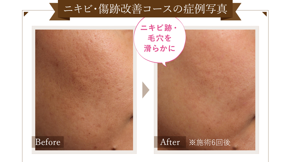 ニキビ・傷跡改善コースの症例写真 Before/After(※施術6回後) ニキビ跡・毛穴が滑らかに!