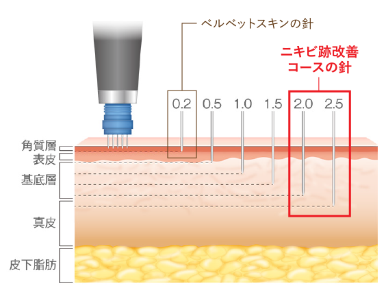 ベルベットスキンの針/ニキビ跡改善コースの針