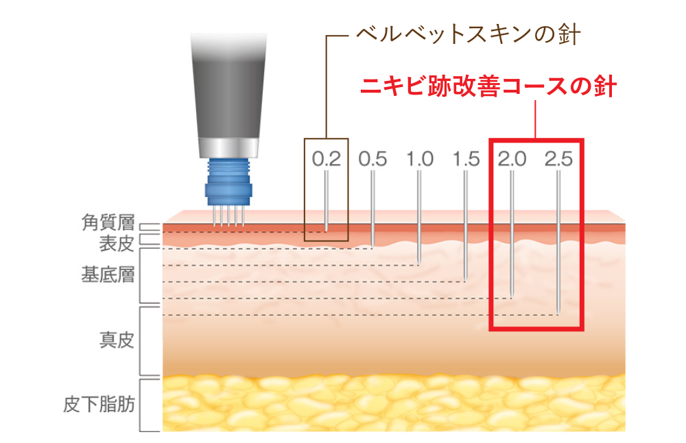 ベルベットスキンの針/ニキビ跡改善コースの針