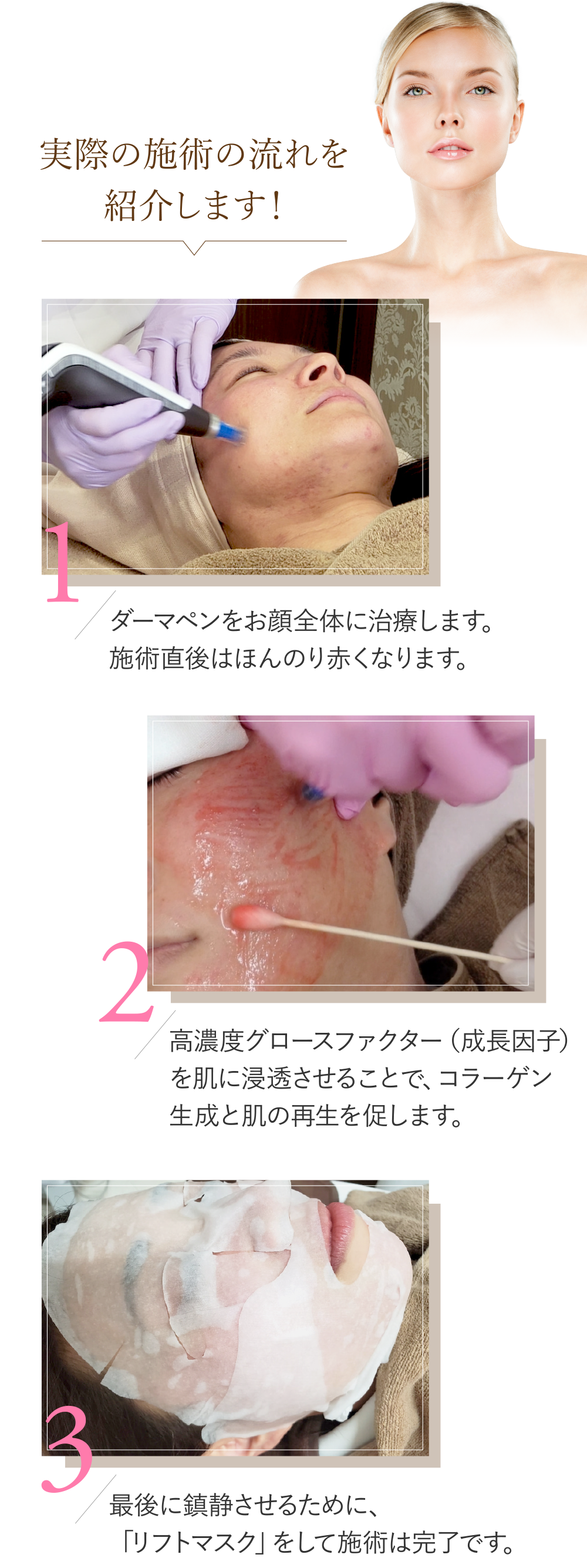 実際の施術の流れを紹介します！(1)ダーマペンをお顔全体に治療します。施術直後はほんのり赤くなります。(2)高濃度グロースファクター（成長因子）を肌に浸透させることで、コラーゲン生成と肌の再生を促します。(3)最後に鎮静させるために、「リフトマスク」をして施術は完了です。