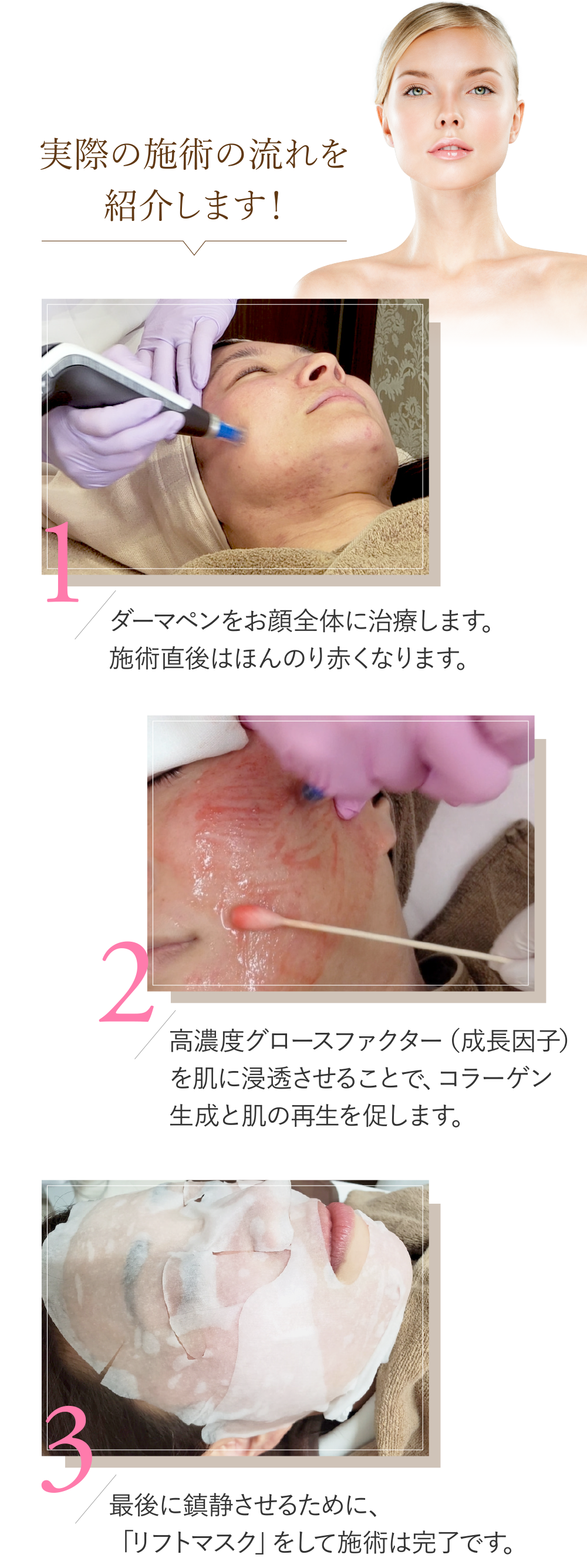 実際の施術の流れを紹介します!(1)ダーマペンをお顔全体に治療します。施術直後はほんのり赤くなります。(2)高濃度グロースファクター(成長因子)を肌に浸透させることで、コラーゲン生成と肌の再生を促します。(3)最後に鎮静させるために、「リフトマスク」をして施術は完了です。