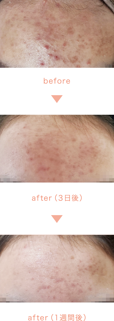 before/after（３日後）/after（１週間後）