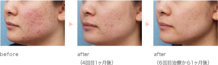 before/after（4回目１ヶ月後）/after（６回目治療から１ヶ月後）