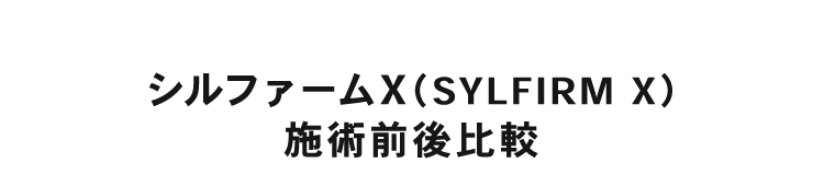シルファームX（SYLFLRM X）施術前後比較