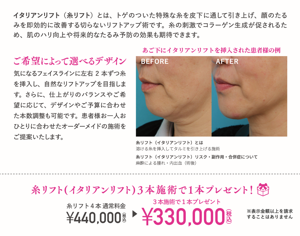 イタリアンリフト（糸リフト）とは、トゲのついた特殊な糸を皮下に通して引き上げ、顔のたるみを即効的に改善する切らないリフトアップ術です。糸の刺激でコラーゲン生成が促されるため、肌のハリ向上や将来的なたるみ予防の効果も期待できます。／ご希望によって選べるデザイン／気になるフェイスラインに左右2本ずつ糸を挿入し、自然なリフトアップを目指します。さらに、仕上がりのバランスやご希望に応じて、デザインやご予算に合わせた本数調整も可能です。患者様お一人おひとりに合わせたオーダーメイドの施術をご提案いたします。／あご下にイタリアンリフトを挿入された患者様の例／糸リフト（イタリアンリフト）とは　溶ける糸を挿入してタルミを引き上げる施術／糸リフト（イタリアンリフト）リスク・副作用・合併症について　麻酔による腫れ・内出血（術後）／糸リフト(イタリアンリフト)3本施術で1本プレゼント！／糸リフト4本通常料金 ¥440,000（税込）→3本施術で1本プレゼント¥330,000（税込）／※表示金額以上を請求することはありません