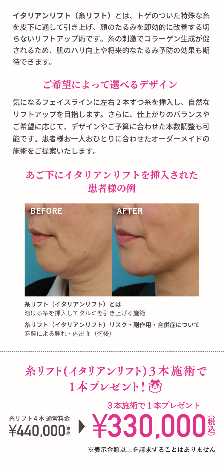 イタリアンリフト（糸リフト）とは、トゲのついた特殊な糸を皮下に通して引き上げ、顔のたるみを即効的に改善する切らないリフトアップ術です。糸の刺激でコラーゲン生成が促されるため、肌のハリ向上や将来的なたるみ予防の効果も期待できます。／ご希望によって選べるデザイン／気になるフェイスラインに左右2本ずつ糸を挿入し、自然なリフトアップを目指します。さらに、仕上がりのバランスやご希望に応じて、デザインやご予算に合わせた本数調整も可能です。患者様お一人おひとりに合わせたオーダーメイドの施術をご提案いたします。／あご下にイタリアンリフトを挿入された患者様の例／糸リフト（イタリアンリフト）とは　溶ける糸を挿入してタルミを引き上げる施術／糸リフト（イタリアンリフト）リスク・副作用・合併症について　麻酔による腫れ・内出血（術後）／糸リフト(イタリアンリフト)3本施術で1本プレゼント！／糸リフト4本通常料金 ¥440,000（税込）→3本施術で1本プレゼント¥330,000（税込）／※表示金額以上を請求することはありません