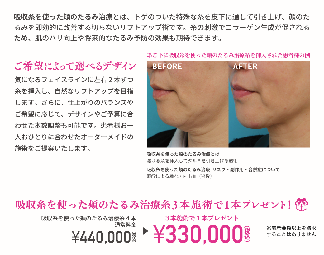吸収糸を使った頬のたるみ治療とは、トゲのついた特殊な糸を皮下に通して引き上げ、顔のたるみを即効的に改善する切らないリフトアップ術です。糸の刺激でコラーゲン生成が促されるため、肌のハリ向上や将来的なたるみ予防の効果も期待できます。／ご希望によって選べるデザイン／気になるフェイスラインに左右2本ずつ糸を挿入し、自然なリフトアップを目指します。さらに、仕上がりのバランスやご希望に応じて、デザインやご予算に合わせた本数調整も可能です。患者様お一人おひとりに合わせたオーダーメイドの施術をご提案いたします。／あご下に吸収糸を使った頬のたるみ治療糸を挿入された患者様の例／吸収糸を使った頬のたるみ治療とは　溶ける糸を挿入してタルミを引き上げる施術／吸収糸を使った頬のたるみ治療 リスク・副作用・合併症について　麻酔による腫れ・内出血（術後）／吸収糸を使った頬のたるみ治療糸3本施術で1本プレゼント！／吸収糸を使った頬のたるみ治療糸4本通常料金 ¥440,000（税込）→3本施術で1本プレゼント¥330,000（税込）／※表示金額以上を請求することはありません
