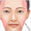 ヒアルロン酸チークヒアル（ヒアルロン酸で頬やこめかみをふっくら）