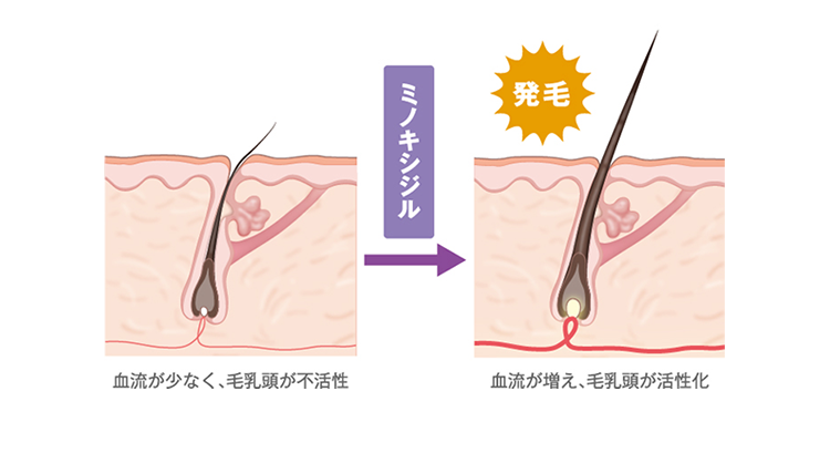 血流が少なく、毛乳頭が不活性→ミノキシジル→【発毛】血流が増え、毛乳頭が活性化