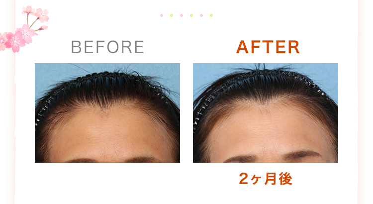 BEFORE/AFTER(2ヶ月後)