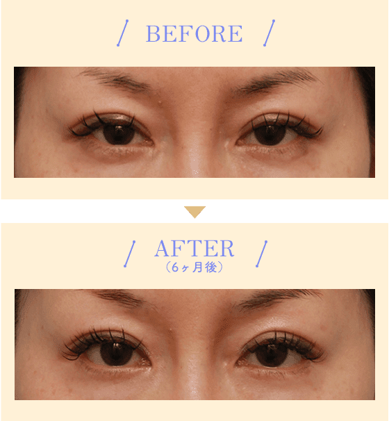 BEFORE/AFTER（6ヶ月後）