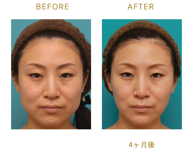 BEFORE/AFTER(4ヶ月後)
