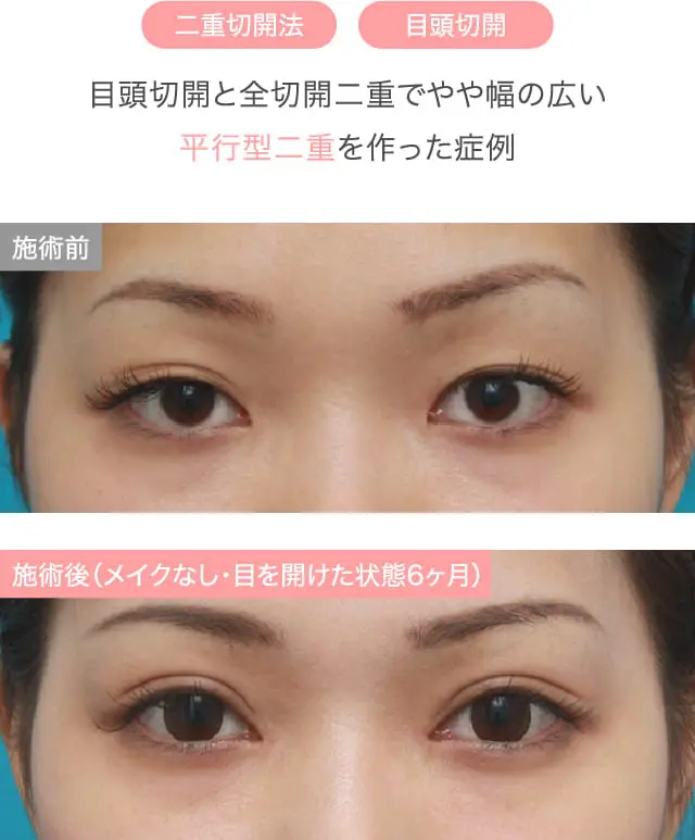 幅広並行二重になった施術例
