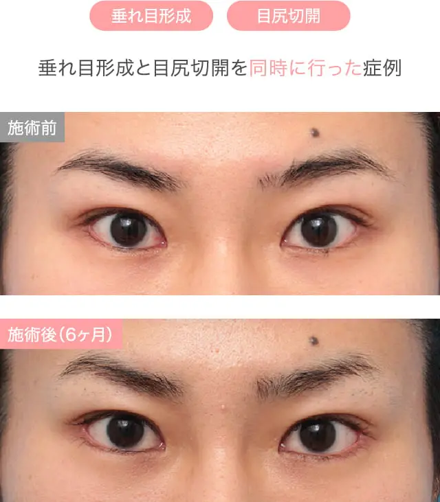 キツイ目を優しくした施術例