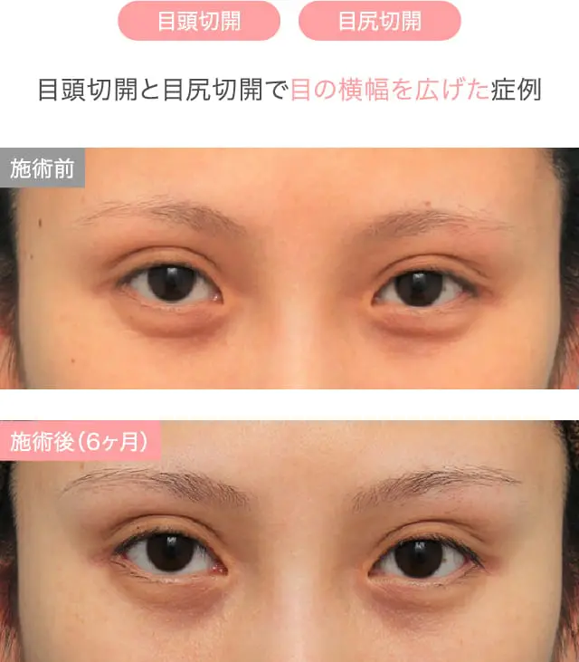 目の横幅をしっかり広くした施術例