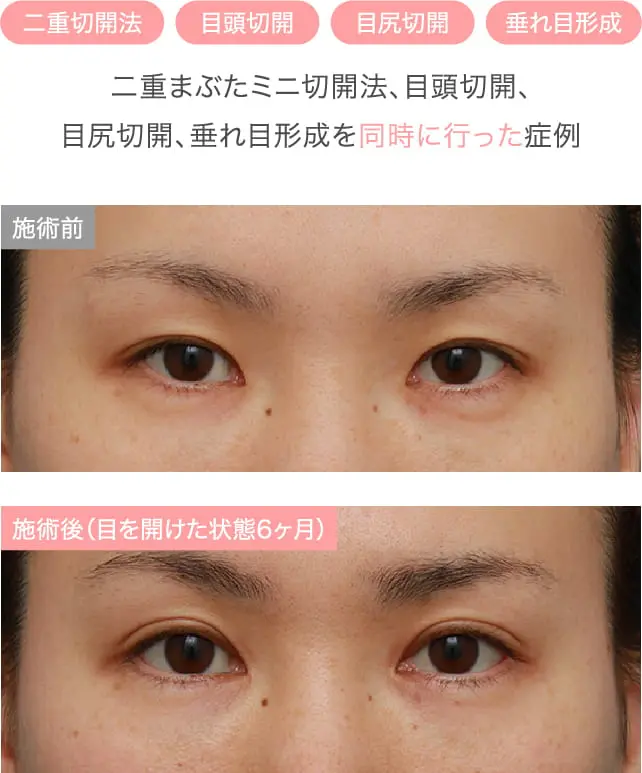パッチリ大きな垂れ目になった施術例