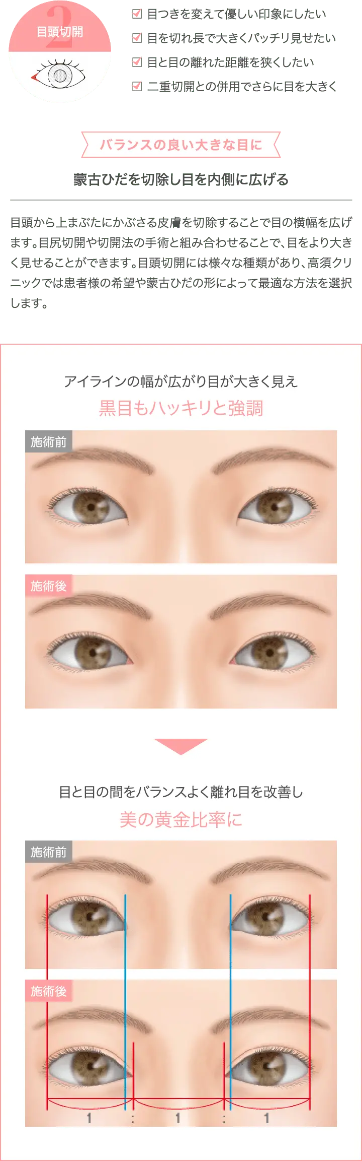 目頭切開法のメリットを表した画像