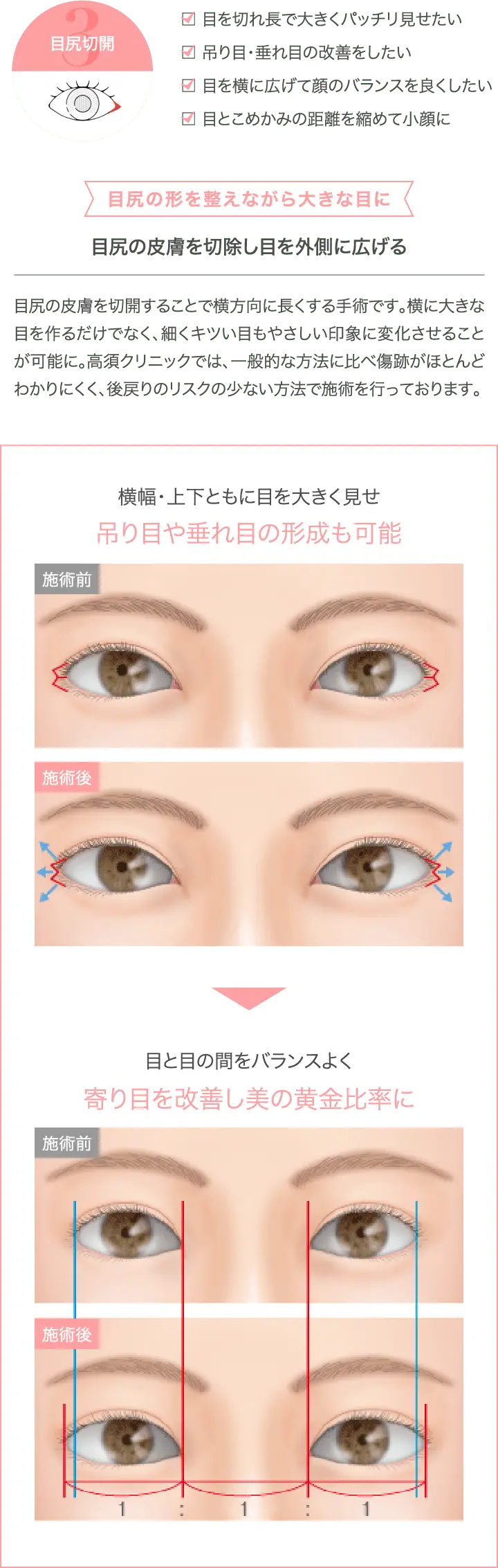 目尻切開法のメリットを表した画像