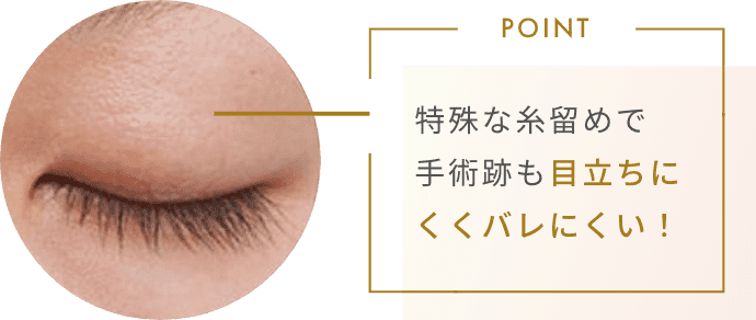 POINT 特殊な糸留めで手術跡も目立ちにくくバレにくい！