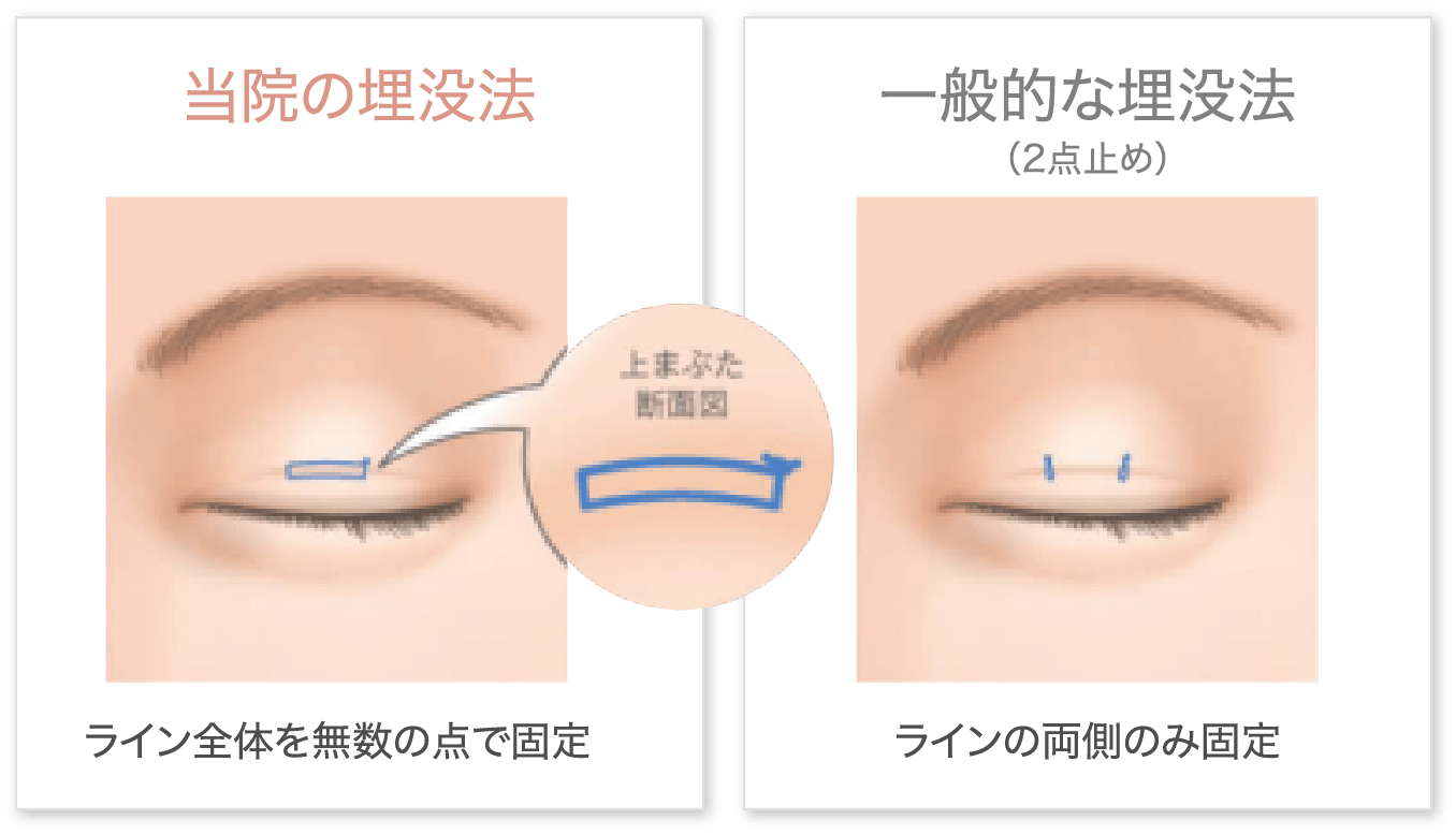 当院の埋没法　一般的な埋没法