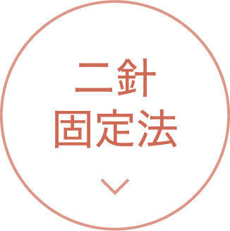二針固定法